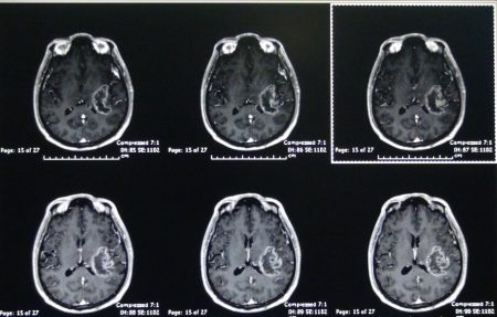 การผ่าตัดสมองแบบผู้ป่วยตื่น (Awake Craniotomy) กับการทำงานเป็นทีมของศัลยแพทย์ วิสัญญีแพทย์ และผู้ป่วย