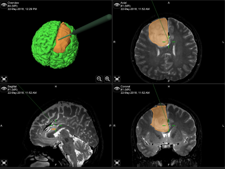 การผ่าตัดสมองแบบผู้ป่วยตื่น (Awake Craniotomy) กับการทำงานเป็นทีมของศัลยแพทย์ วิสัญญีแพทย์ และผู้ป่วย