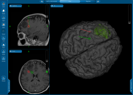 การผ่าตัดสมองแบบผู้ป่วยตื่น (Awake Craniotomy) กับการทำงานเป็นทีมของศัลยแพทย์ วิสัญญีแพทย์ และผู้ป่วย