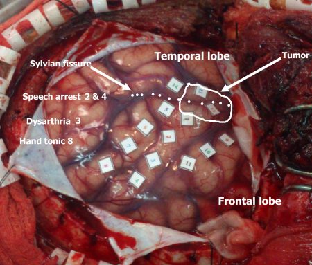การผ่าตัดสมองแบบผู้ป่วยตื่น (Awake Craniotomy) กับการทำงานเป็นทีมของศัลยแพทย์ วิสัญญีแพทย์ และผู้ป่วย